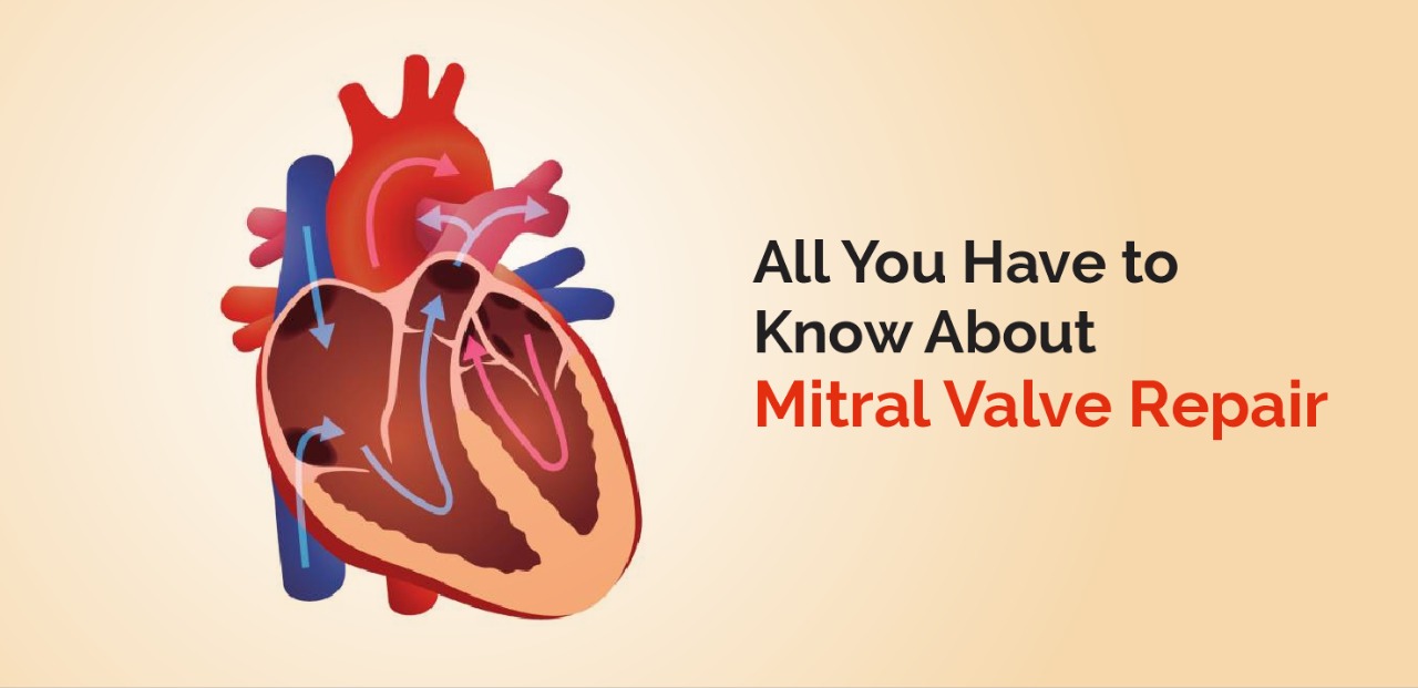 All You Have To Know About Mitral Valve Repair